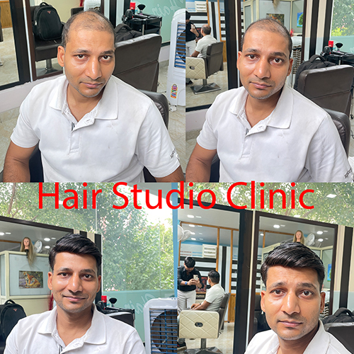 Best Hair Patch Service in Delhi